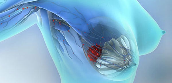 CTCs as prognostic markers for metastatic breast cancer